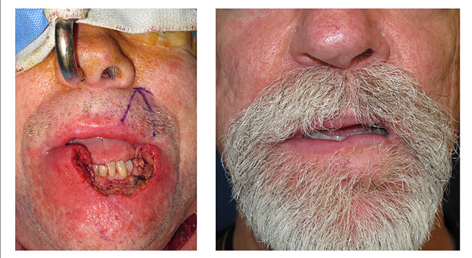 facial reconstruction before and after photo