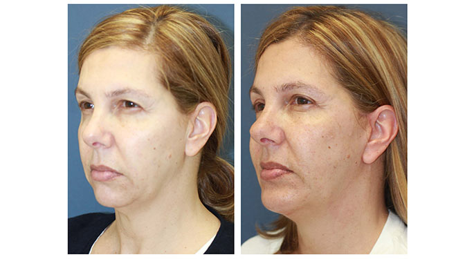 facial rejuvenation before and after photo