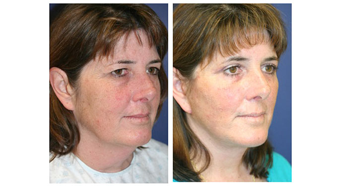 facial rejuvenation before and after photo