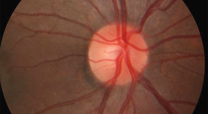 Image of Optical nerves at the division of Neuro-Ophthalmology
