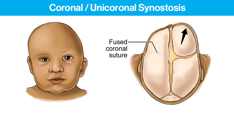 Coronal / Unicoronal Synostosis