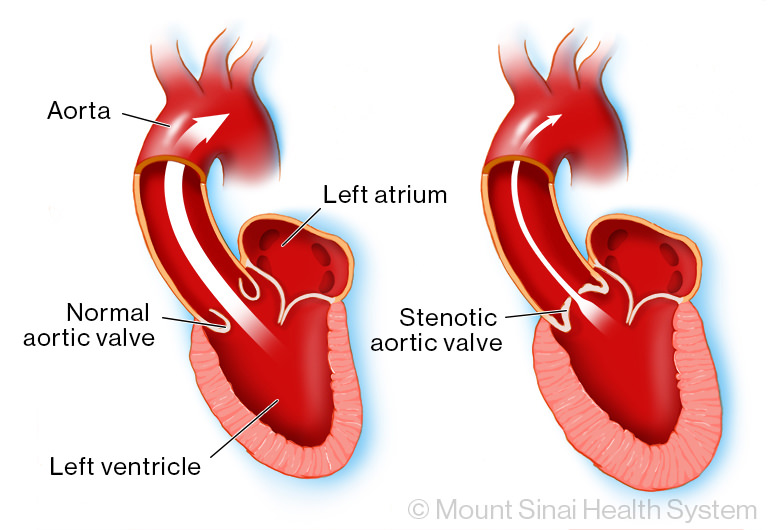 A normal aortic valve compared with a narrow valve