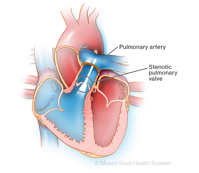 Pulmonary valve stenosis illustration
