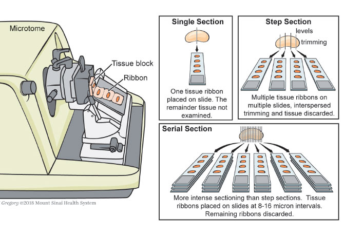 An illustration shows multilevel sectioning used by Dr. Urken’s team of pathologists and researchers on the original tissue blocks. Results were then reviewed by a senior pathologist.