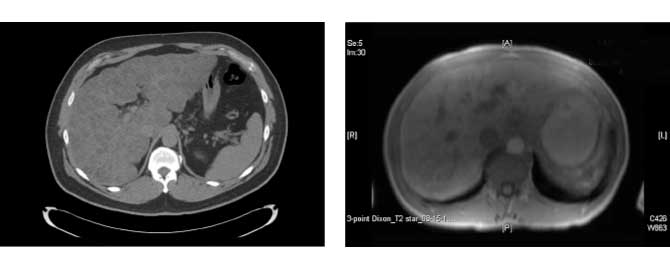 A CT scan and an MRI of liver sarcoidosis cases from Mount Sinai Health System