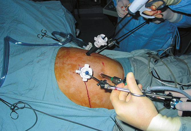 image of insulinoma removal