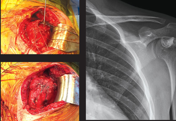 X-ray demonstrates left shoulder bone graft healing after surgery