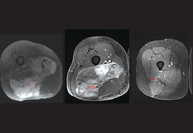 MRI of the right thigh showing a large tumor in the posterior compartment of the thigh
