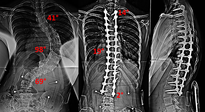 X-ray images of Young Spine Patient, Ruth, before and after corrective surgery