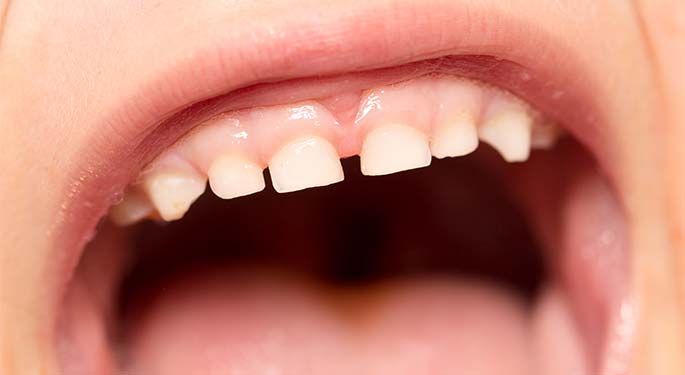Image of child's teeth