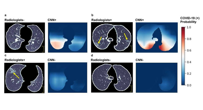 Examples of chest CT images of COVID-19