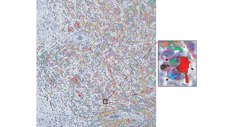 Study Reveals a Trio of Immune Cells Vital in Response to Liver Cancer  Immunotherapy