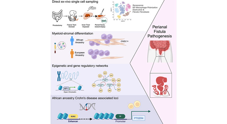 Crohns Disease infographic