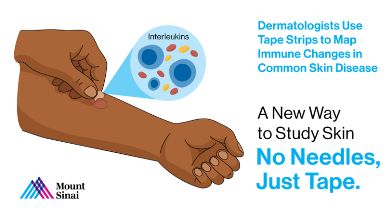 テープストリップで皮膚疾患の免疫変化をマッピング(Mount Sinai Dermatologists Use Tape Strips to Map Immune Changes in Common Skin Disease)