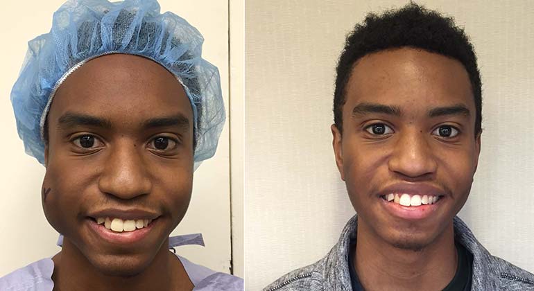 Venous Malformation: A Life-Changing Surgery | Mount Sinai - New York