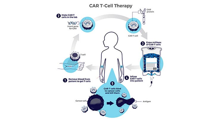 CAR T-cell infographics
