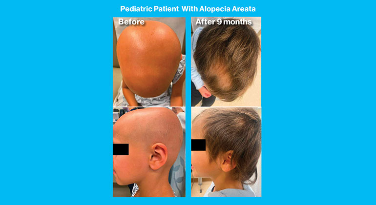 Alopecia Areata images