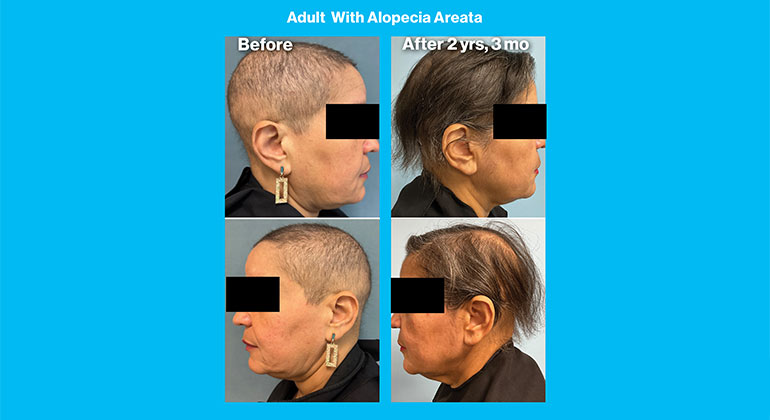 MSHS-Dermatology-AlopeciaAreata-2col-770x420-10.jpg