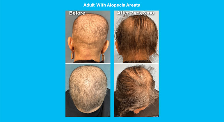 MSHS-Dermatology-AlopeciaAreata-2col-770x420-11.jpg