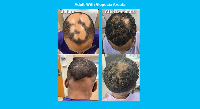 MSHS-Dermatology-AlopeciaAreata-2col-770x420-12.jpg