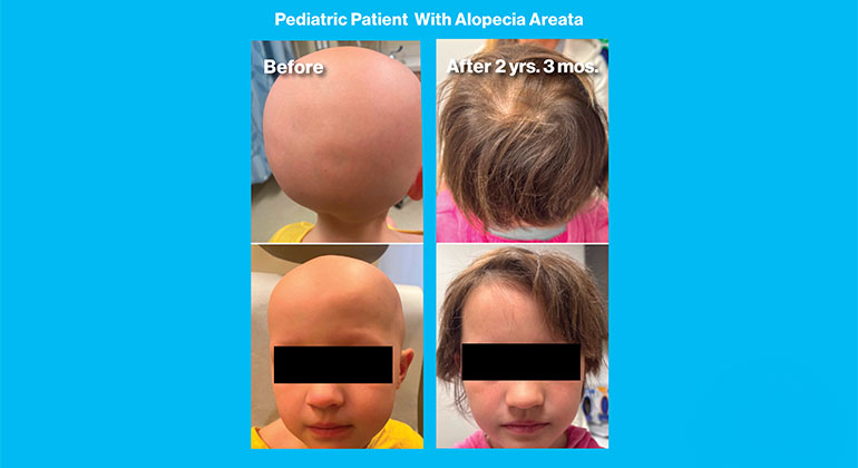 Pediatric Patient With Alopecia Areata