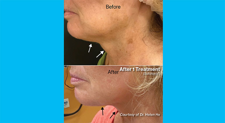 Alopecia before and after image