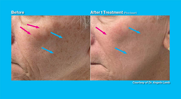 Alopecia before and after image