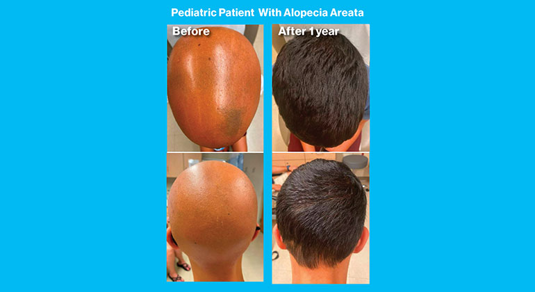 Alopecia Areata images