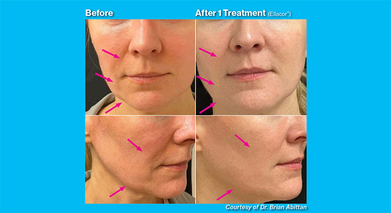Alopecia before and after image