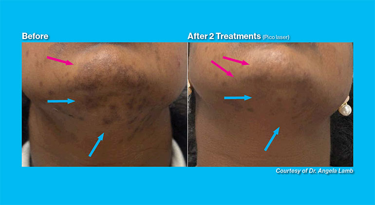Alopecia before and after image