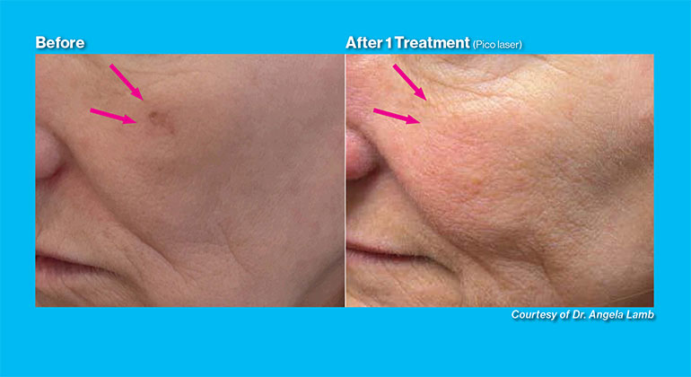 Alopecia before and after image
