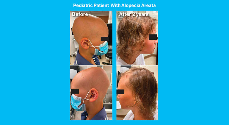 Alopecia Areata images