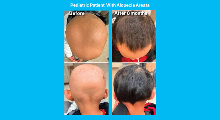 Alopecia Areata images