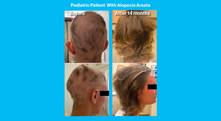 Alopecia Areata images