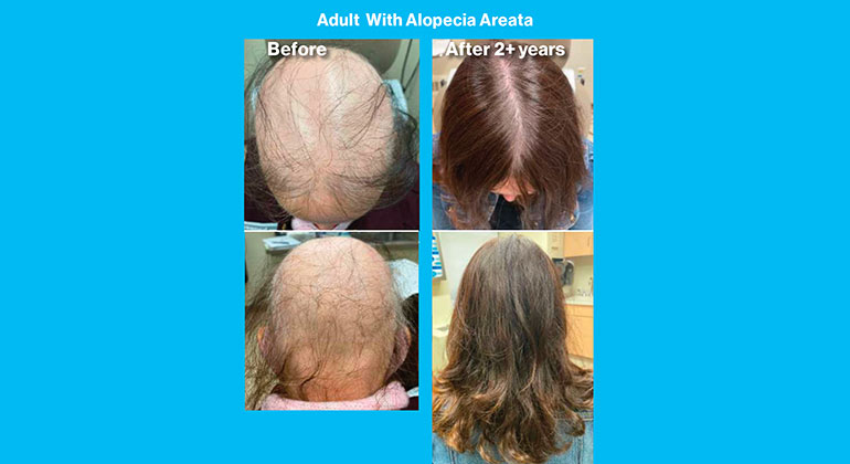 Alopecia Areata images