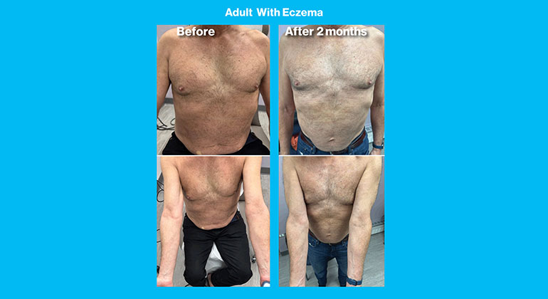 patient skin condition before and after treatment