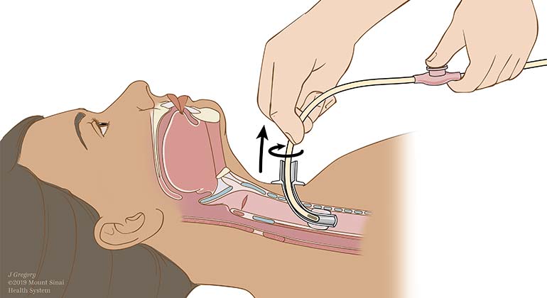 Suctioning a Trachestomy