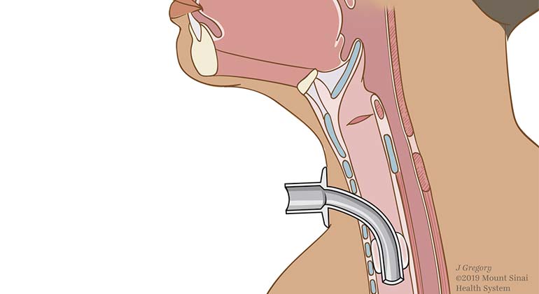 Cross section of a Trachestomy tube in patient