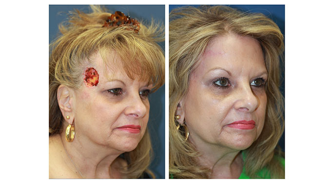 facial reconstruction before and after photo