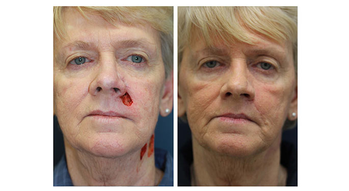 Before and After, Facial Plastic Surgery Center