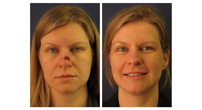 Facial Reconstruction Before & After Gallery | Mount Sinai - New York