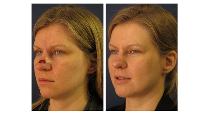 Facial Reconstruction Before & After Gallery | Mount Sinai - New York