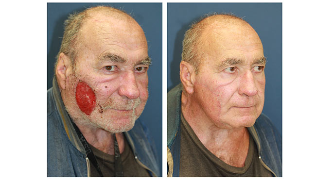 facial reconstruction before and after photo