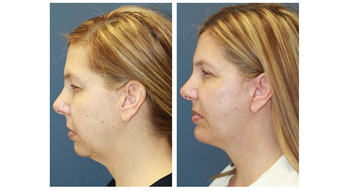 facial rejuvenation before and after photo