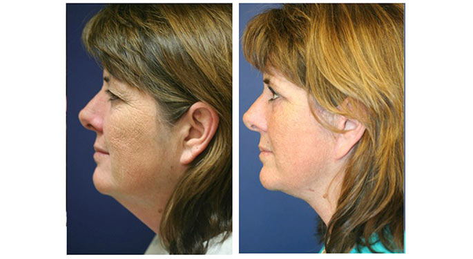 facial rejuvenation before and after photo