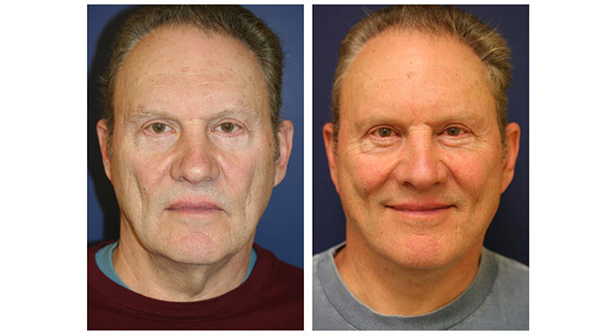 facial rejuvenation before and after photo