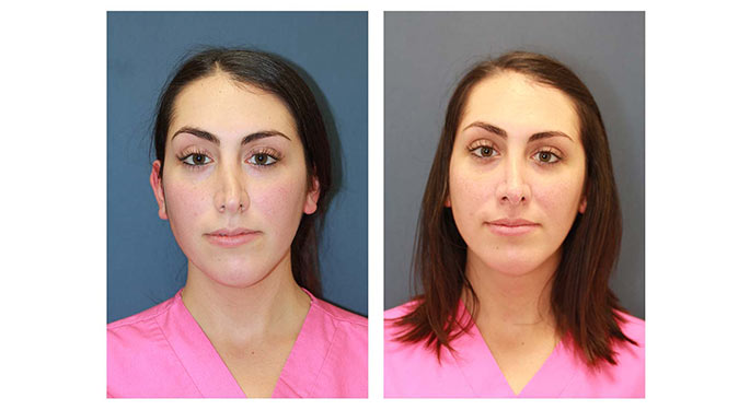 Rhinoplasty before and after photo