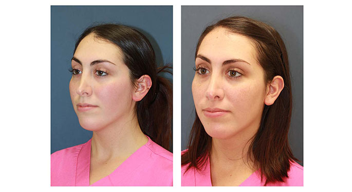 Rhinoplasty before and after photo