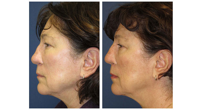 Rhinoplasty before and after photo