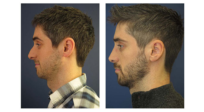 Rhinoplasty before and after photo